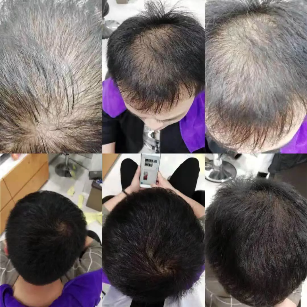 脱发掉发效果对比