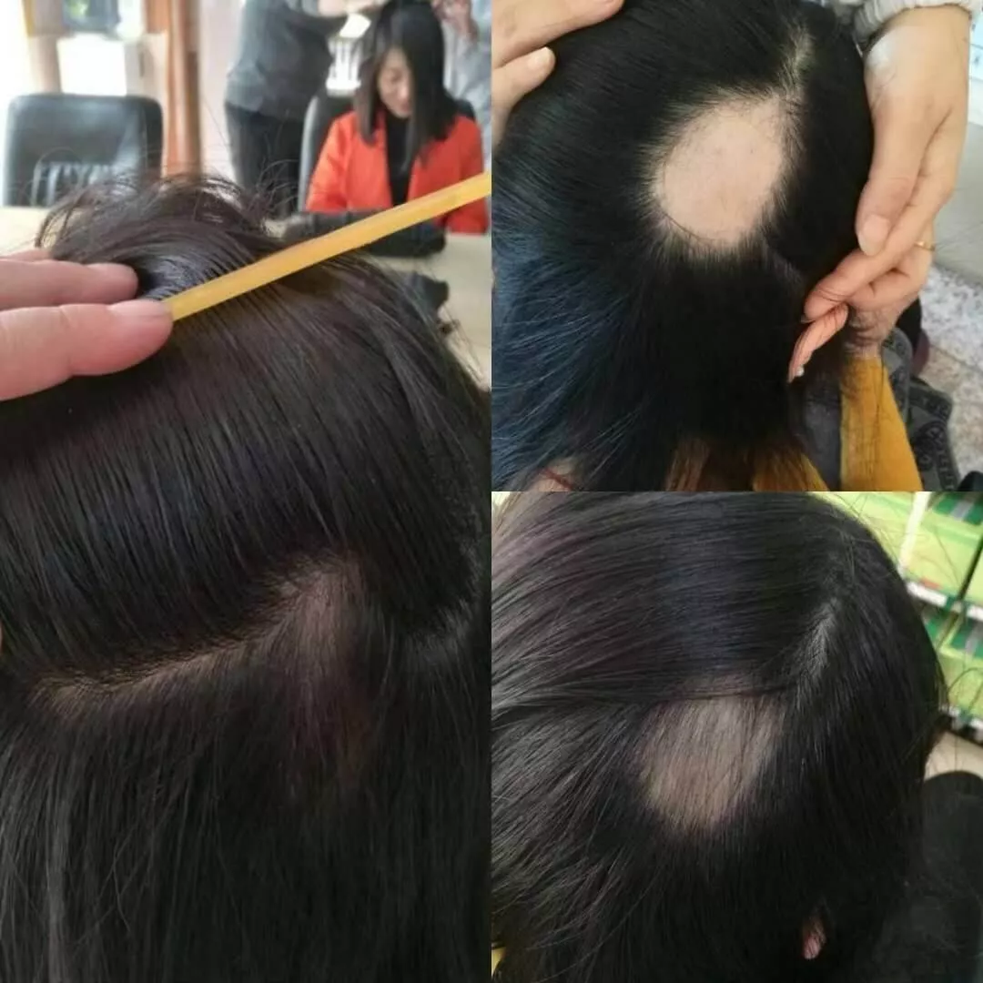 斑秃前后对比