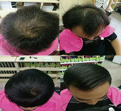 脱发效果对比